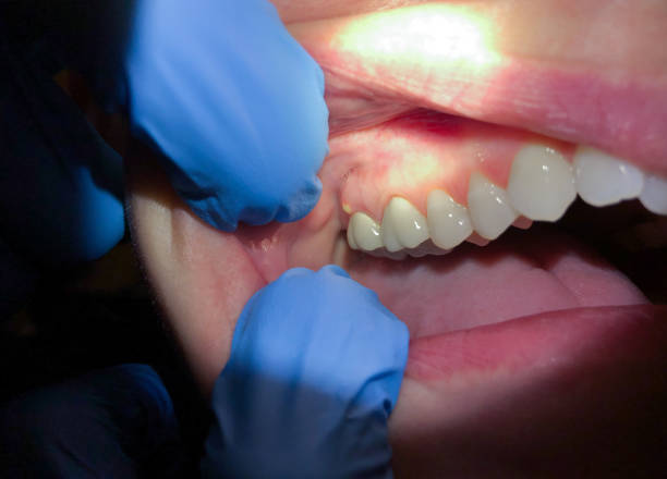 Best Root Canal Emergency Dentist  in Wfield, IN