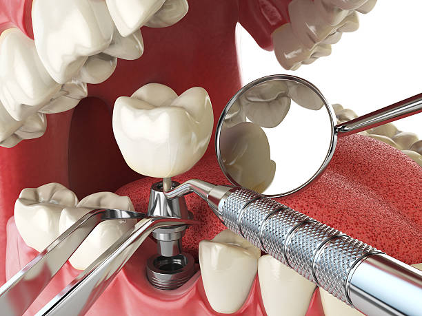 Best Cracked Tooth Emergency Dentist  in Wfield, IN